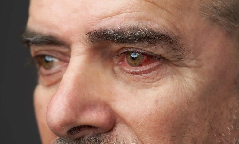 ચેતજો! આંખો હંમેશા રહે છે લાલ! આ છે ડ્રાય આઈ સિન્ડ્રોમના લક્ષણો 1 thenewsdk.in